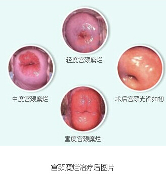 济宁宫颈糜烂